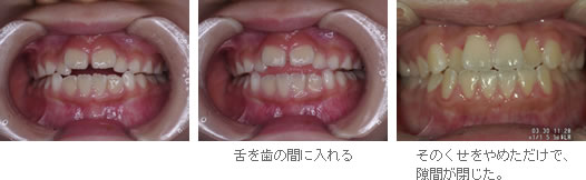 日本小児歯科学会 小学生低学年