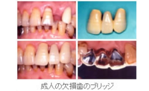 成人の欠損歯のブリッジ