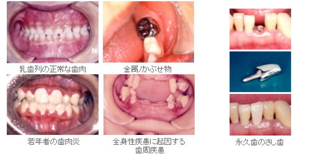 若年層の歯肉炎　全身性疾患に起因する歯周疾患　永久歯のさし歯