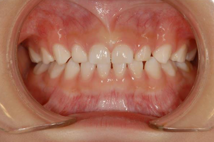 図4 むし歯がなく健全な乳歯(男児 4.2歳)