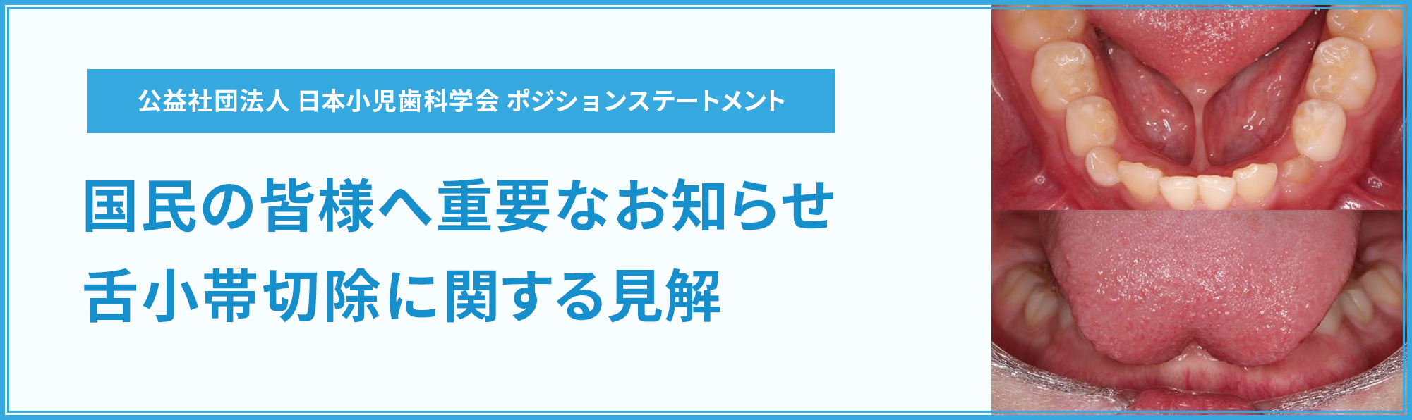 公益社団法人 日本小児歯科学会 ポジションステートメント 国民の皆様へ重要なお知らせ 舌小帯切除に関する見解